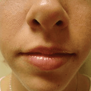 1699652590-hair-removal-upper-lip