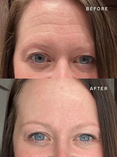 Forehead-Wrinkle-Results