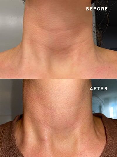 Neck-Wrinkle-Results