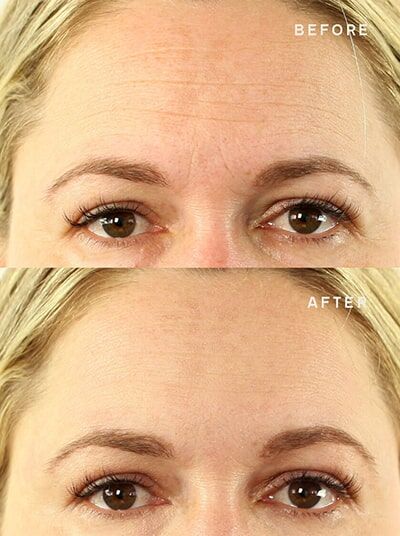 Wrinkle-Reduction-Results-Forehead-Young