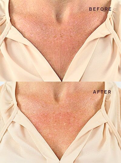 Wrinkle_Reduction_Results_Chest