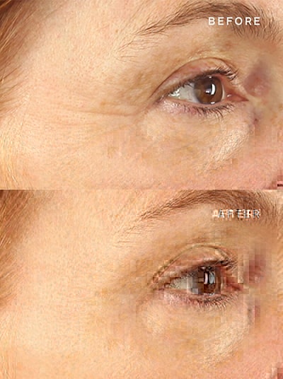 Wrinkle_Reduction_Results_Eyes_Old
