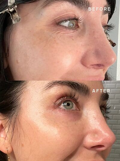 Wrinkle_Reduction_Results_Eyes_Young