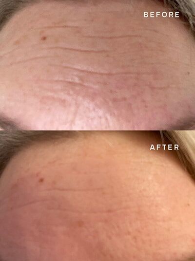 Wrinkle_Reduction_Results_Forehead_Closeup
